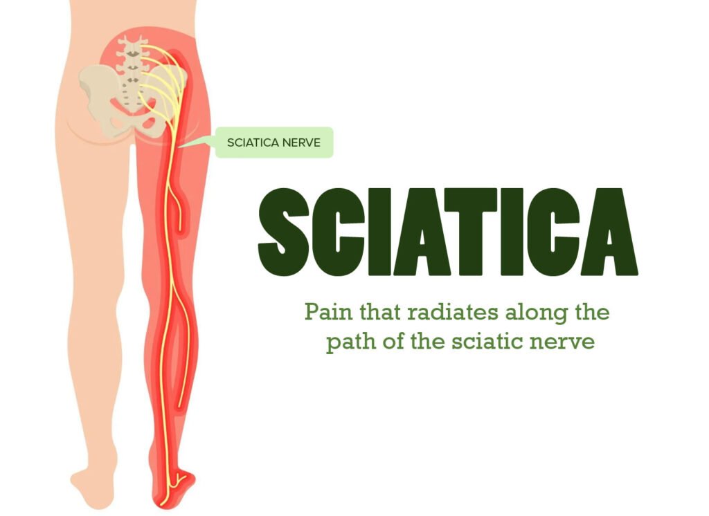 sciatica at hijama in abudhabi