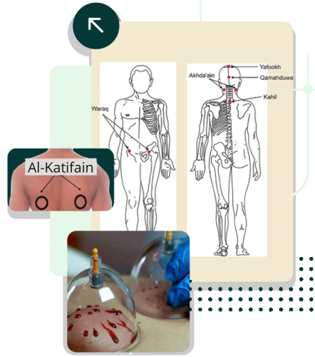 what-is-hijama